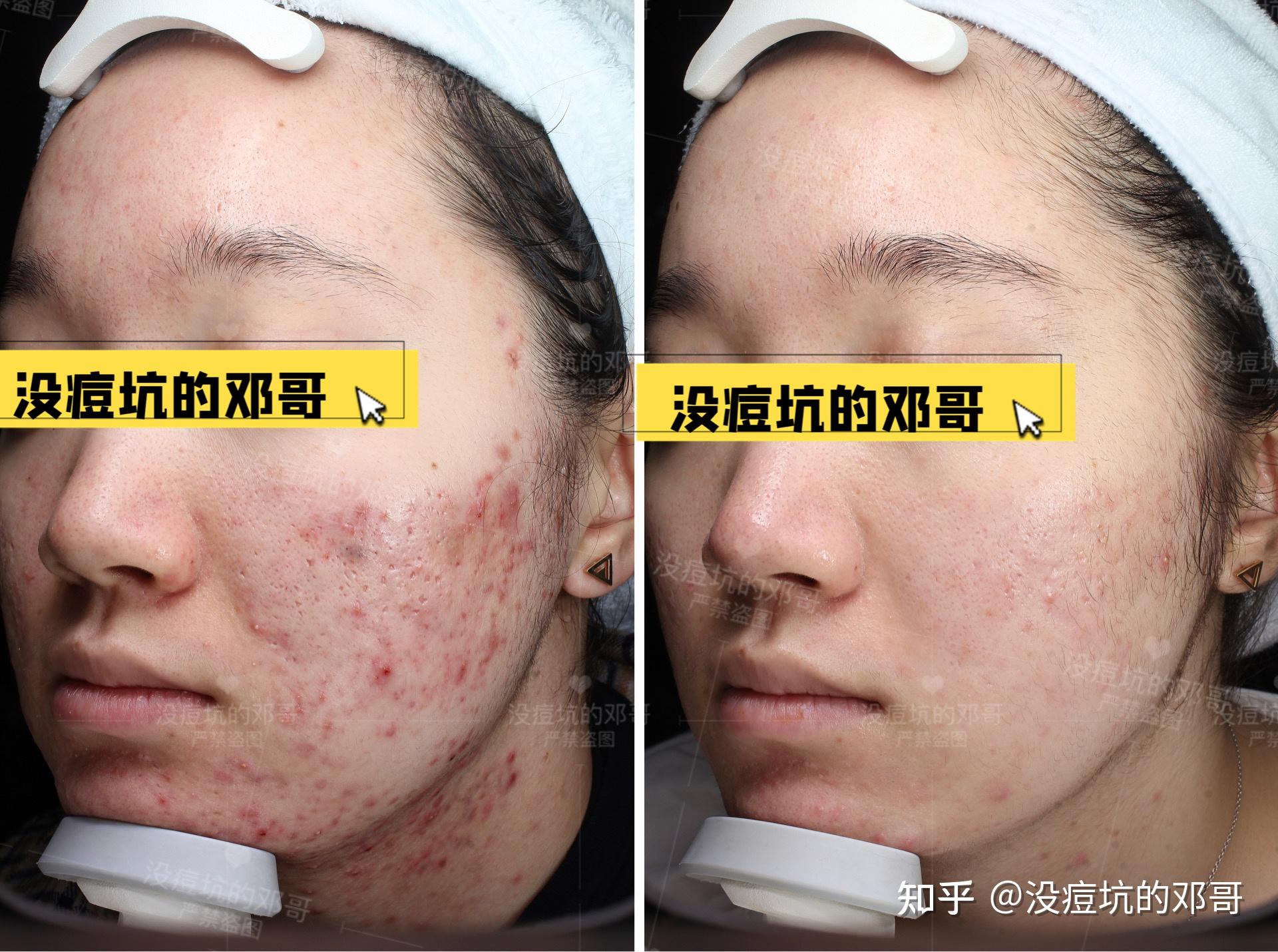 所以挤痘痘的问题到底该不该挤呢?