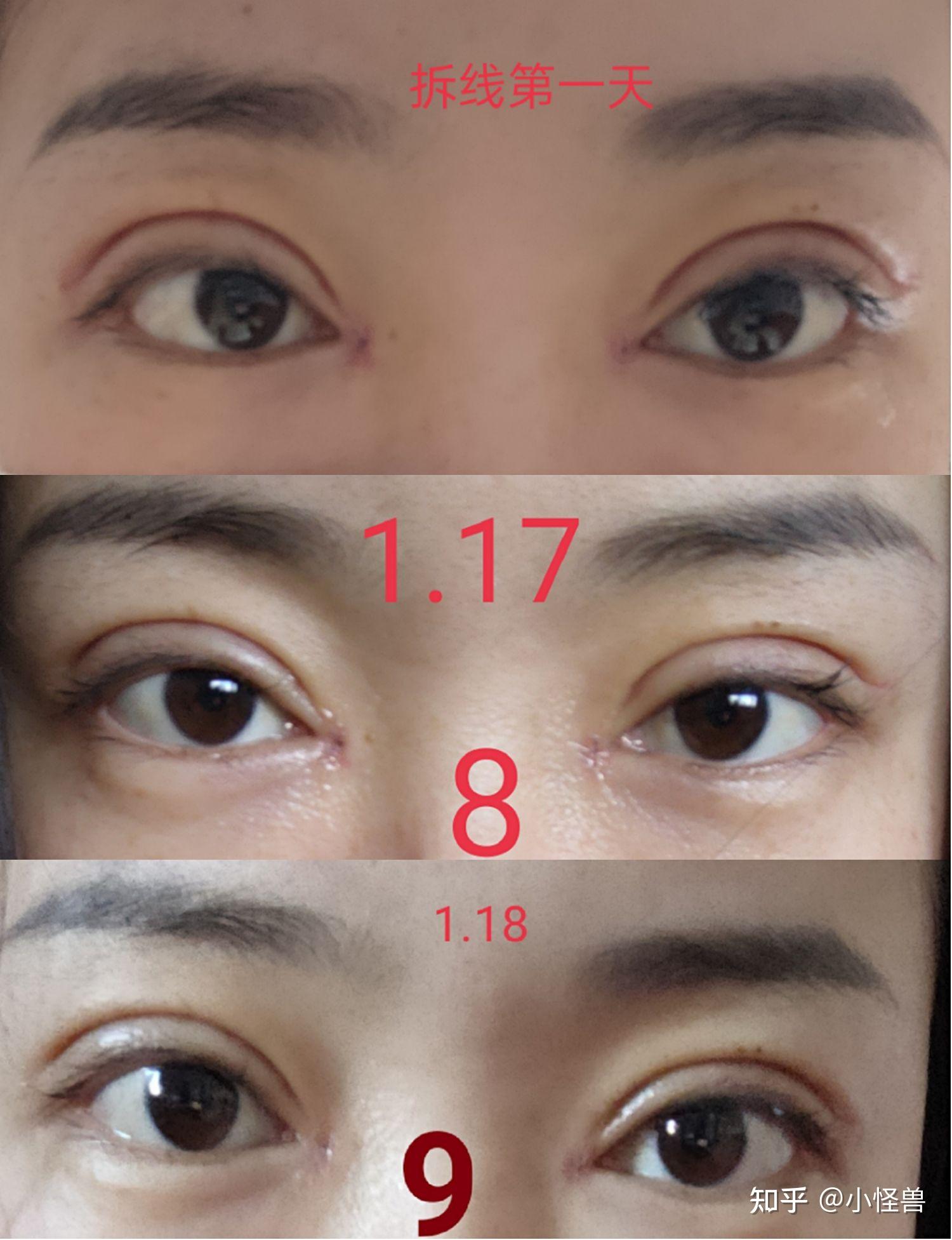 全切双眼皮加开眼角恢复过程