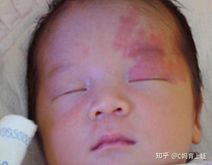 宝宝出现“鹤吻痕”怎么办？家长不要乱处理，做错了有可能会加深颜色 - 知乎