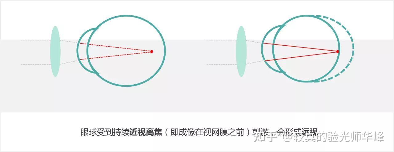 豪雅新乐学多点离焦与蔡司成长乐周边离焦有何不同? - 知乎