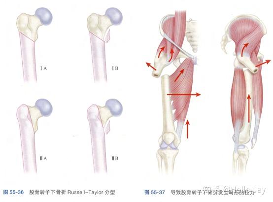 股骨转子下骨折 - 知乎