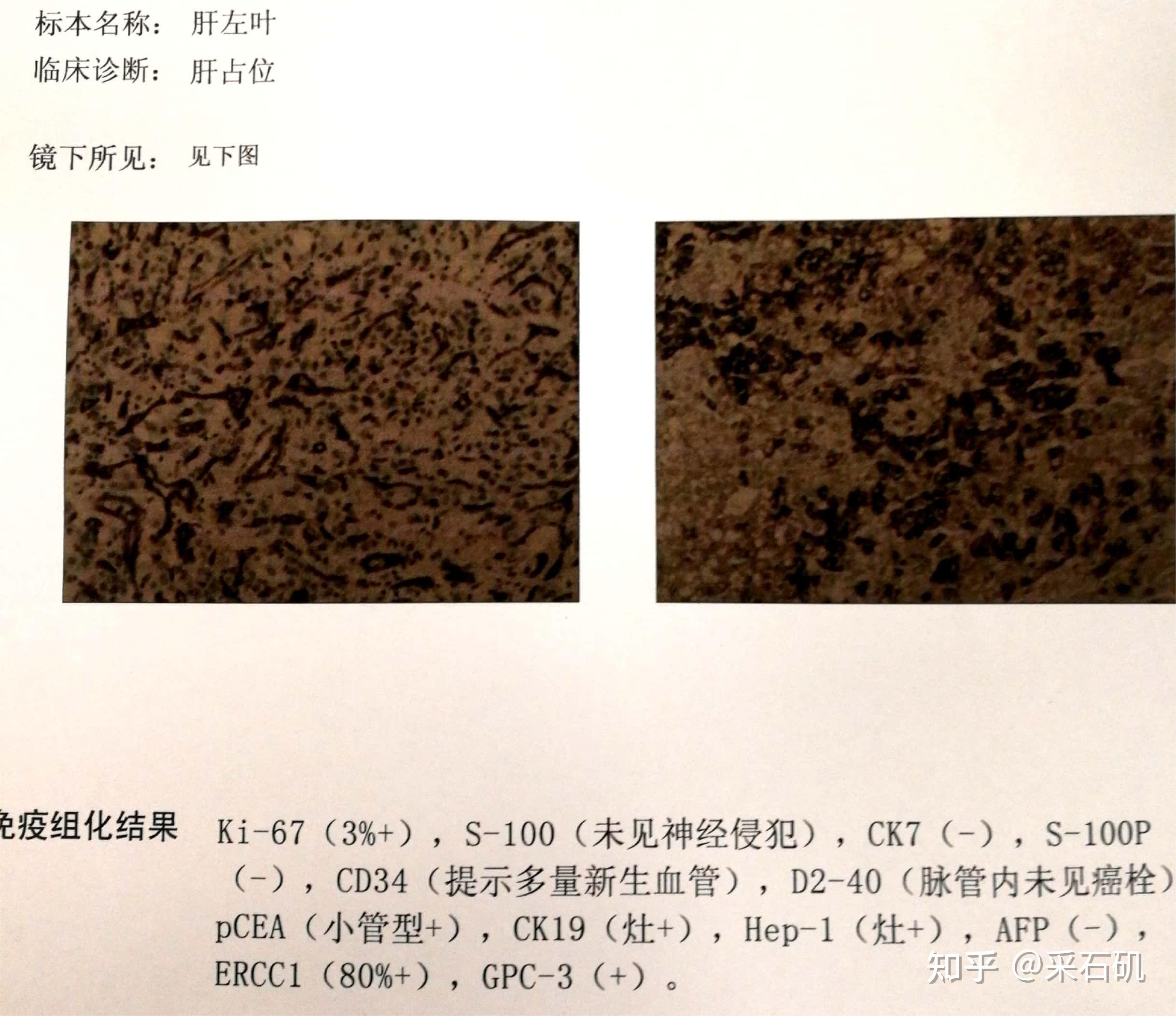 抗癌路上众生相——原发性肝癌篇