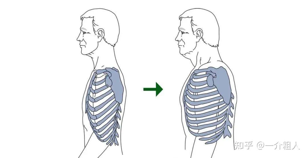 从视诊的角度,桶状胸描述的是一种胸廓前后径增大的病理性现象