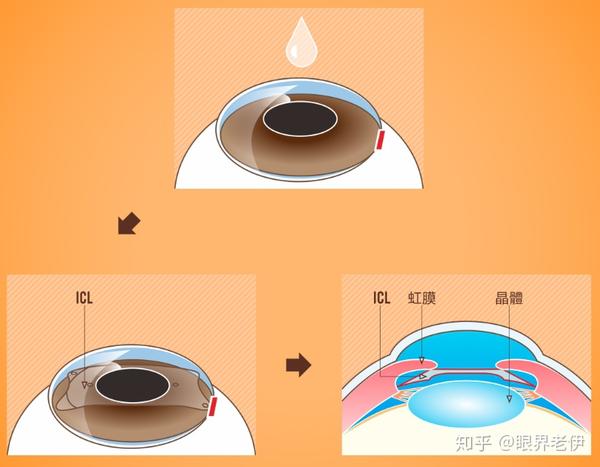 不考虑费用 半飞秒手术和icl晶体植入手术哪个好 虹膜植入手术 趋势网络