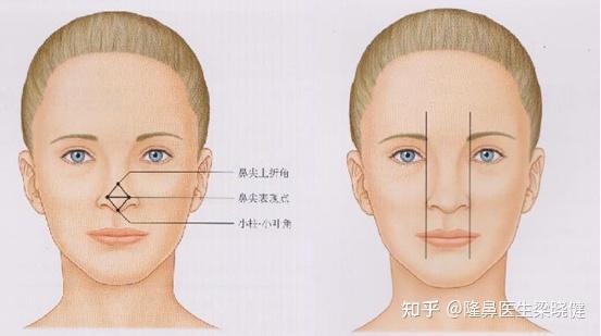 深圳美莱丨结构派综合隆鼻八大技术—XU耳软骨鼻尖三角支架技术 - 知乎