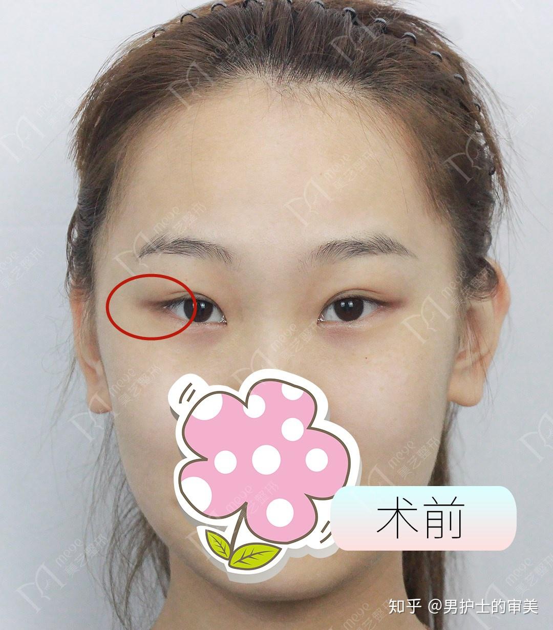 【双眼皮手术科普03】-埋线双眼皮多久能做双眼皮修复？埋线双眼皮和全切双眼皮适合哪些人？ - 知乎