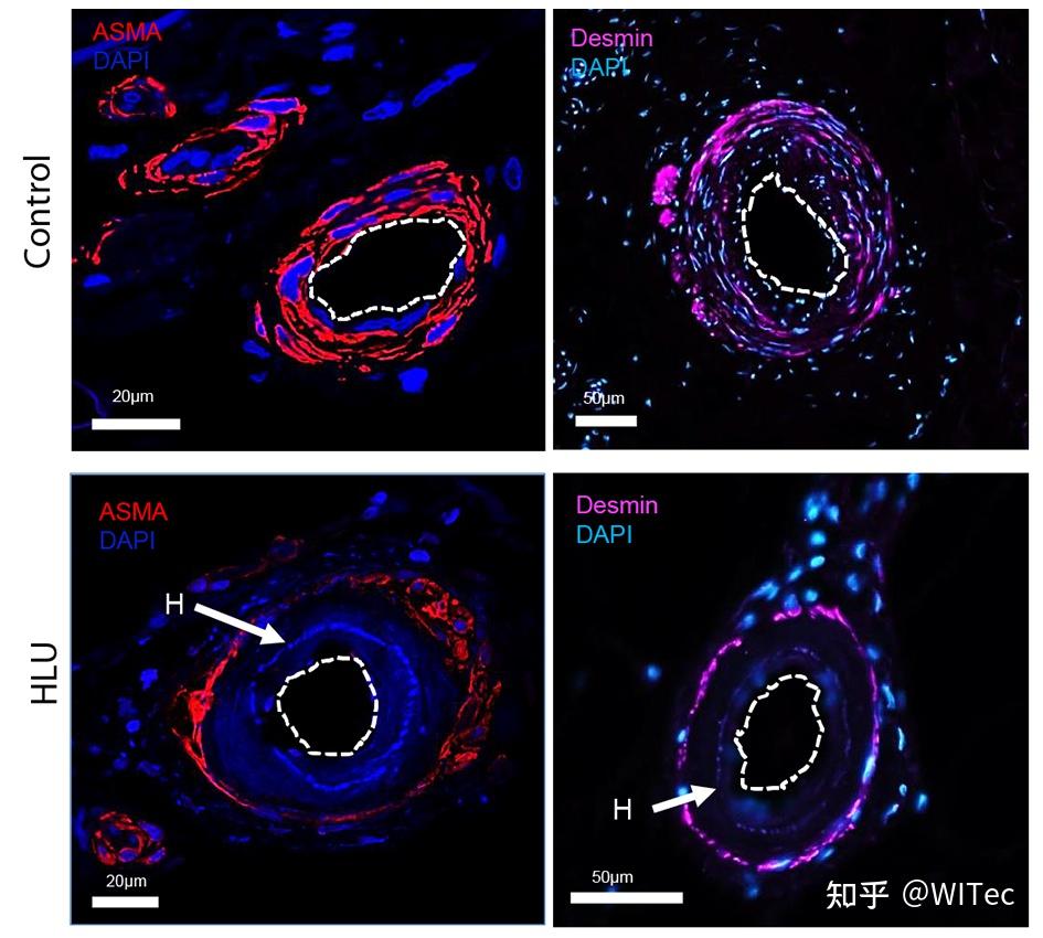 无标记拉曼光谱及成像揭秘动脉硬化性溃疡的发病机理和分子机制