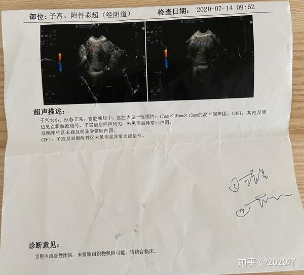 可视无痛人流残留坚持不清宫