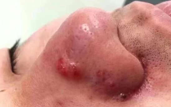 鼻子大而红,该不会是"酒渣鼻"?