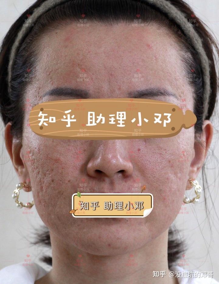 厢车型冰锥型痘坑做了两组激光后的即时反馈对比来了