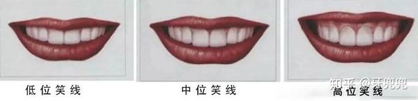 为什么成年人做牙齿矫正越来越在意这两个地方？ - 知乎