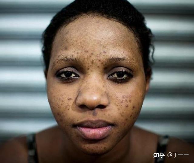 我就是天生黑皮肤?