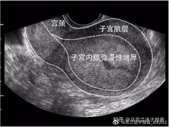 子宫内膜增生 - 知乎