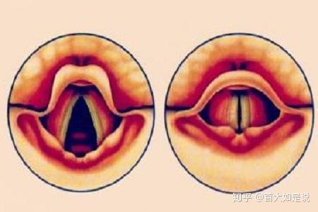 首大陈潜声带沟要如何治疗