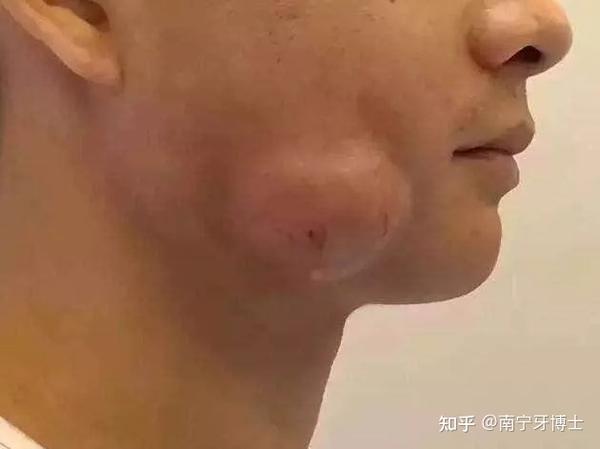 智齿反复发炎 拖着不管 25岁小伙被智齿 捅破 脸 知乎