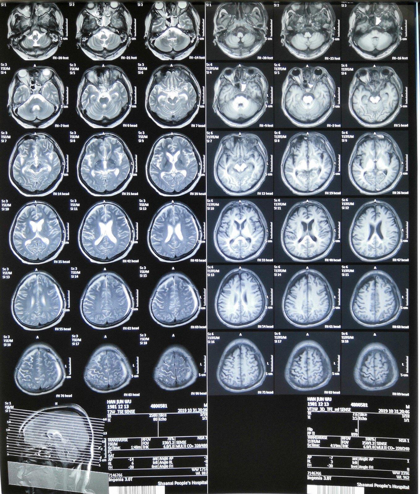 弥漫性轴索损伤昏迷患者还能醒吗