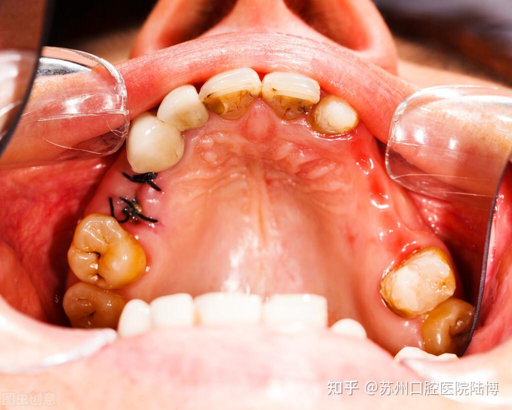 拔牙5天后牙窝愈合过程图图解（拔牙后的"血窟窿"是怎么长好的？了解后再也不用怕拔牙了） | 说明书网