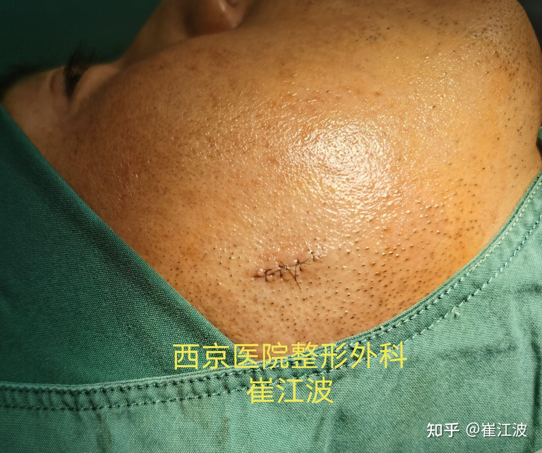 皮脂腺囊肿,俗称"粉瘤",整形外科可完整切除后美容缝合 - 知乎