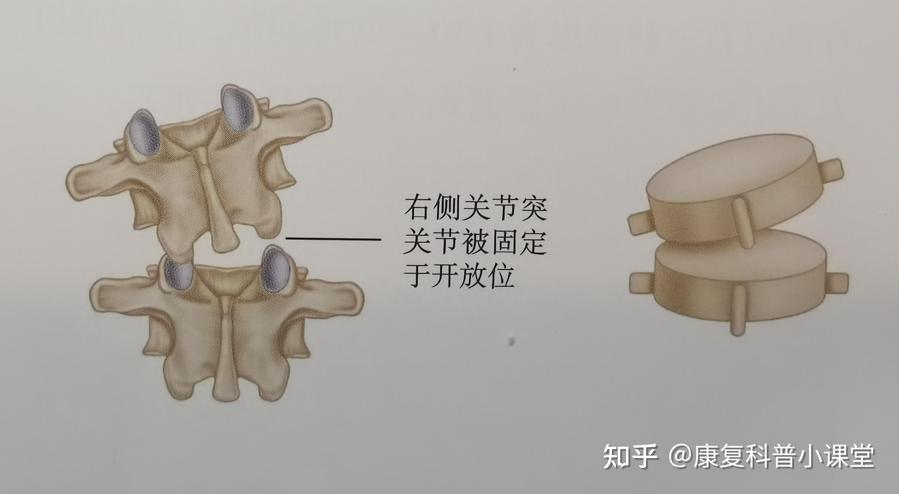 患者l5左側的橫突位置較淺,而右側的橫突較深,從而推斷出腰椎向左旋轉