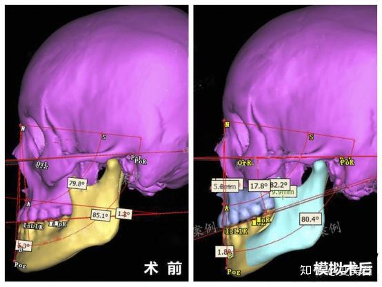 选择郑州磨骨削骨整形医院的原因是什么？