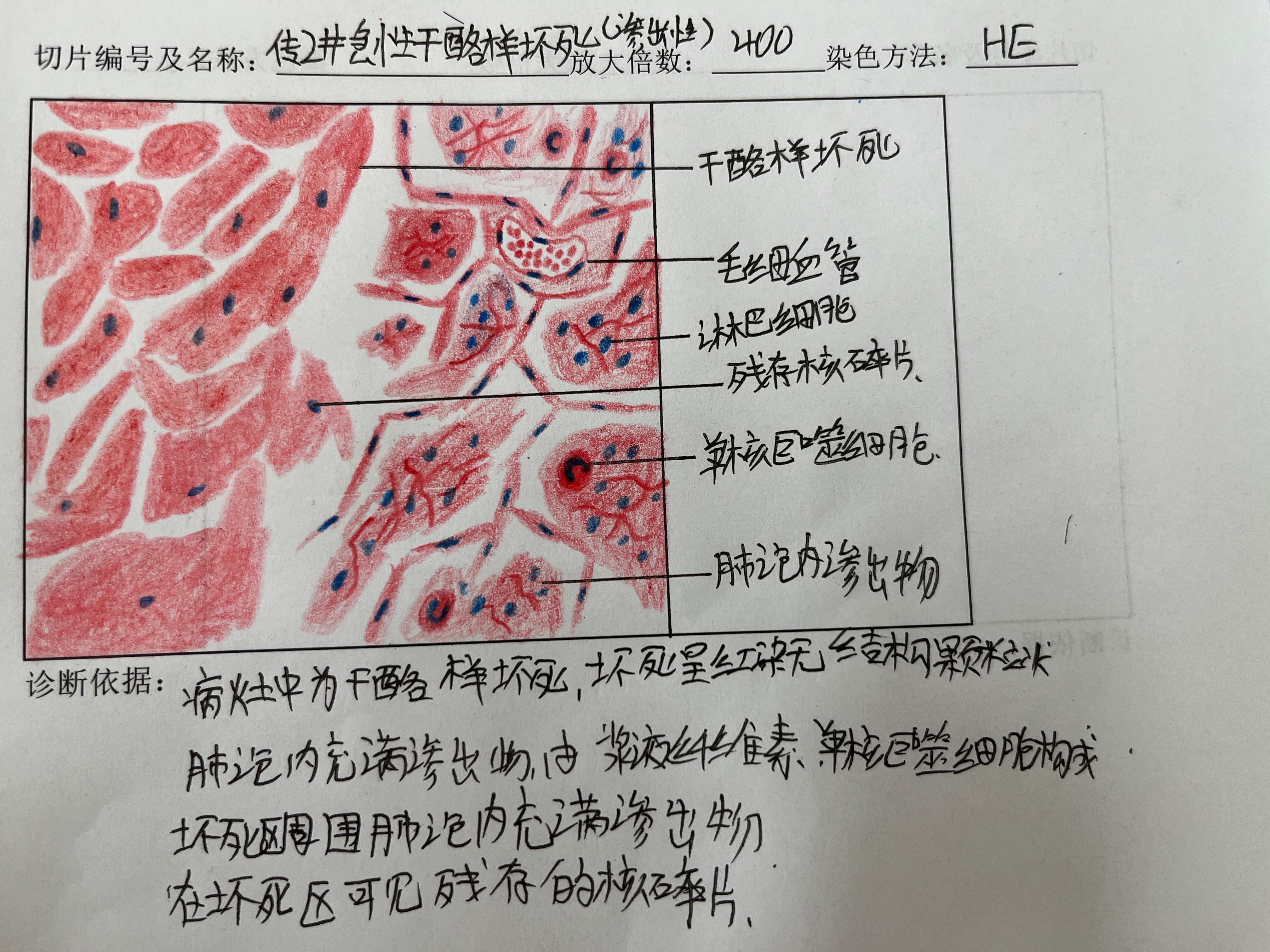 干酪样坏死镜下观图片图片