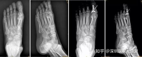 足趾骨骨折案例 从 行动不便 足趾骨折恢复时间 帮果网