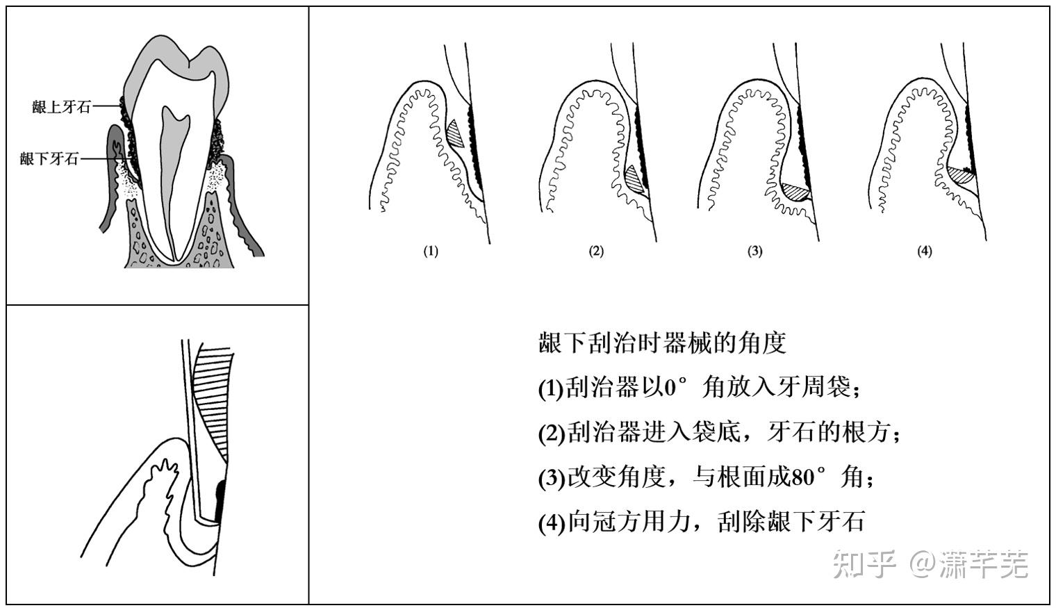 這個時候就需要深層的洗牙進行治療了,即