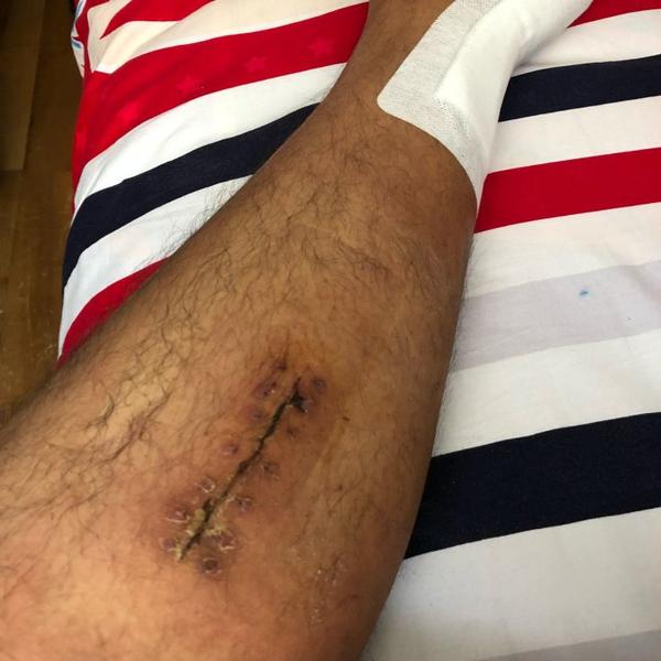跟腱断裂手术恢复记录