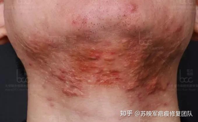 大小红色点状物,痒或不痒,维时半年左右,易被误认为毛囊炎,血管痣等