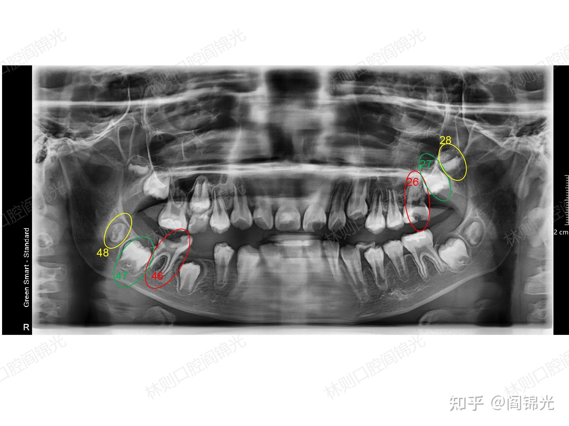 两阶段整复理念与技术在成年牙槽突裂鼻翼基底重建的应用初探