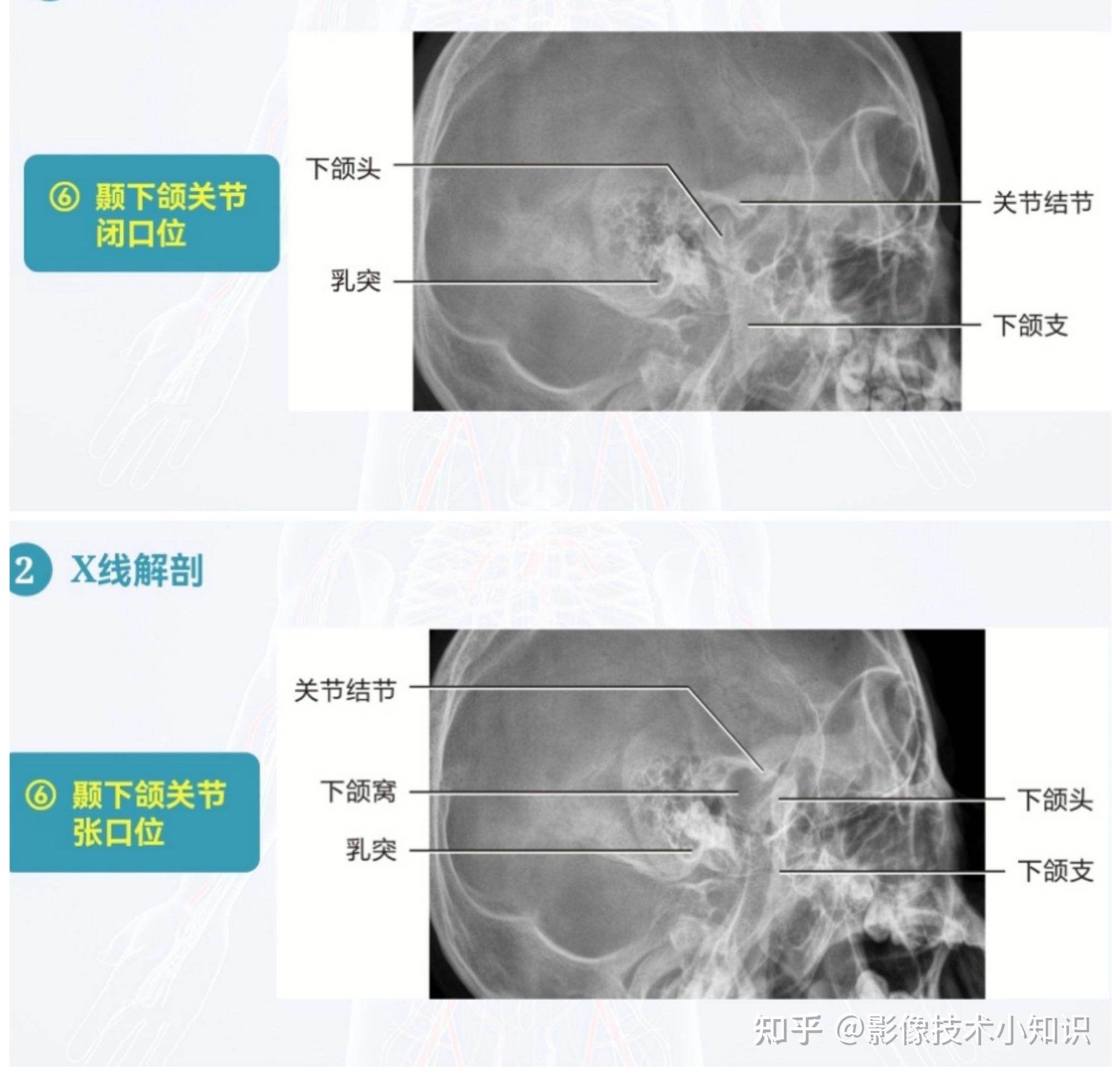 头颅X线摄影及其解剖 - 知乎