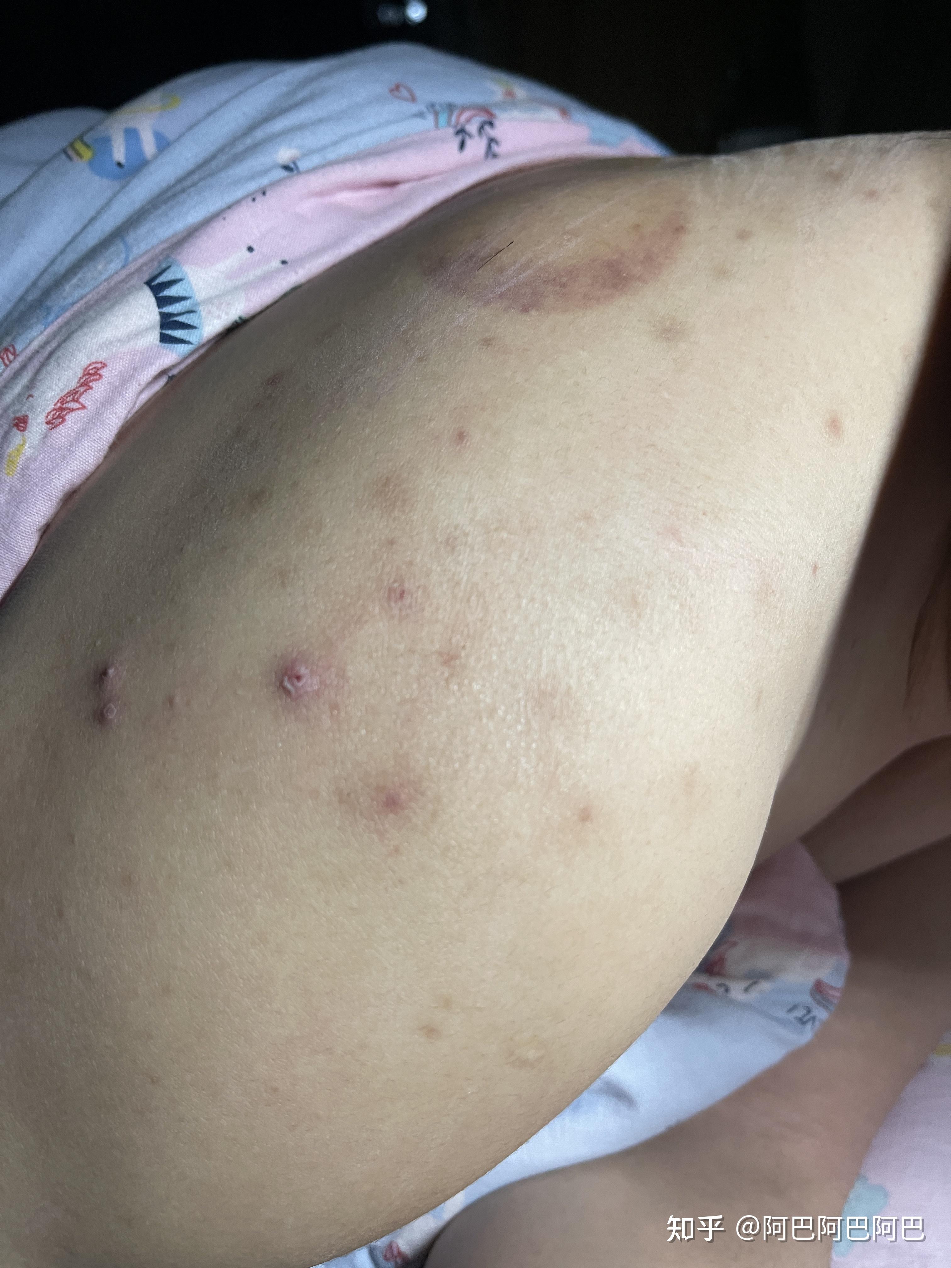 请问左右肩膀后面张痘痘是怎么回事如何治疗有图? - 知乎