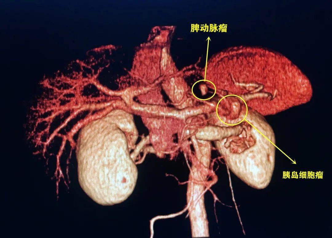 头痛竟是胰腺作祟市三医院成功完成国内首例报道罕见病诊治