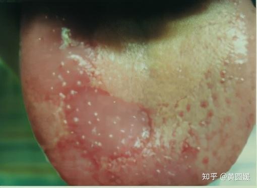 宝宝花剥苔地图舌怎么回事按这三种分型进行调理