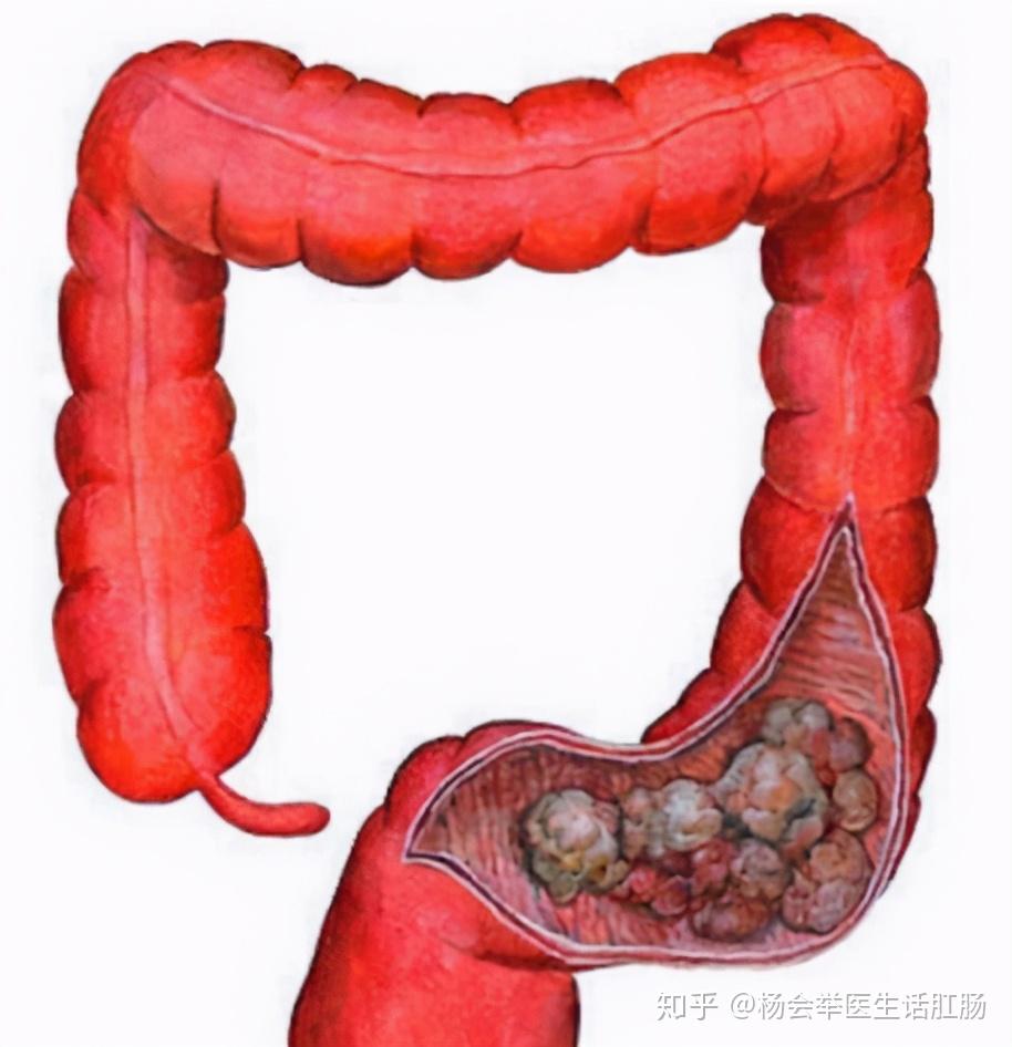 杨医生笔记:一位直肠癌患者便血的惨痛经历