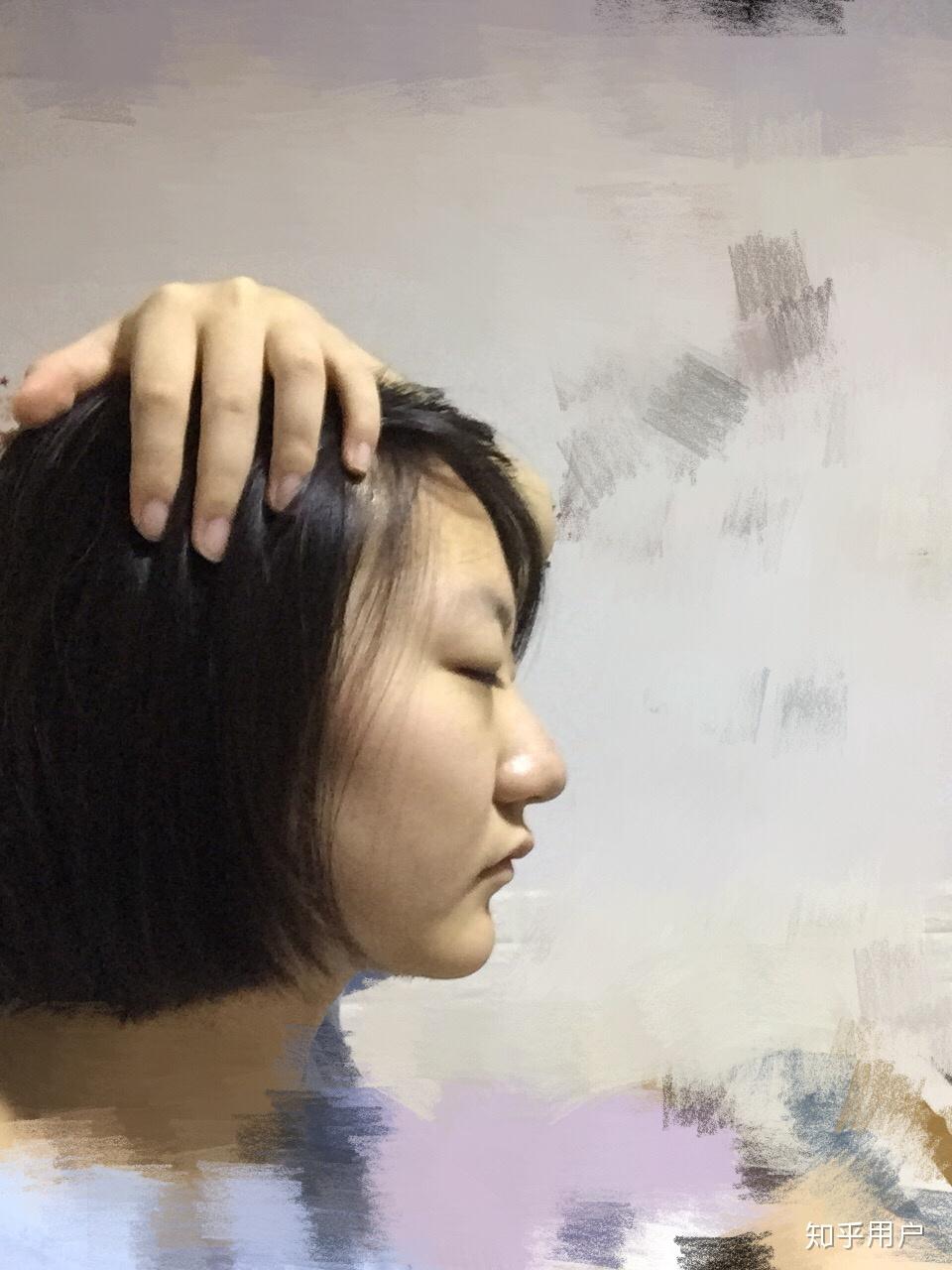侧面看眼睛非常突,眉骨低和鼻子连接不起来是怎么回事?