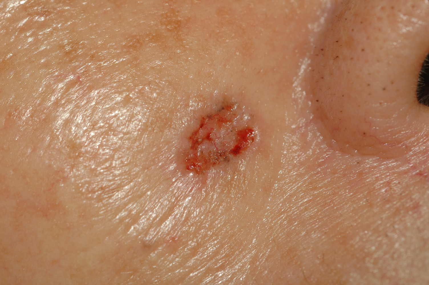 皮肤基底细胞癌早期图片