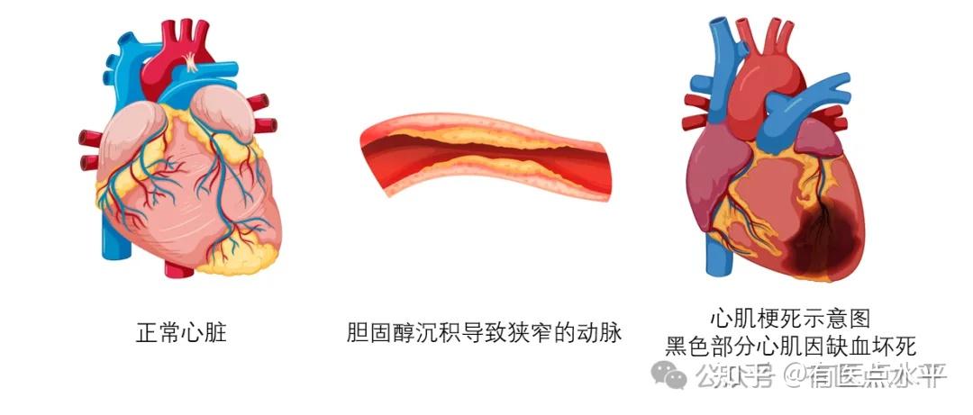 三高系列---高血脂(一) - 知乎