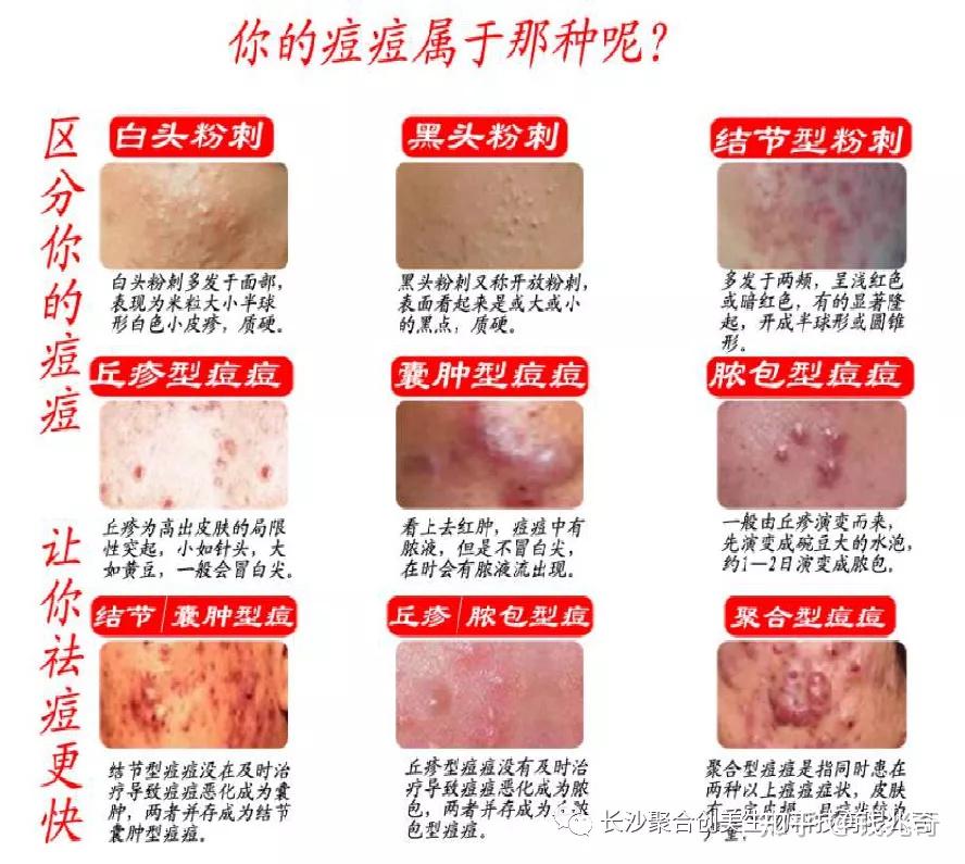 问题性肌肤的种类及成因 - 知乎
