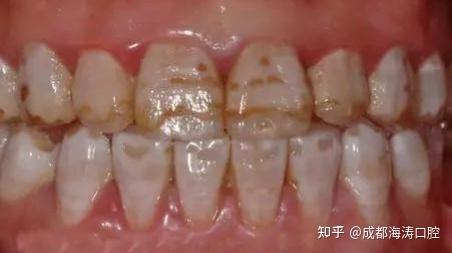 怎么看自己是不是氟斑牙?怎么才能变白?看这里!