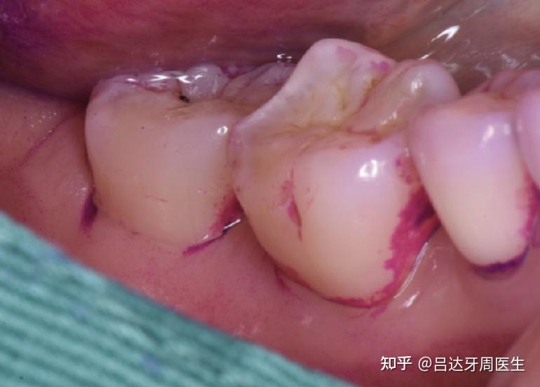 用牙线,真的会损伤牙龈吗?关键在方法