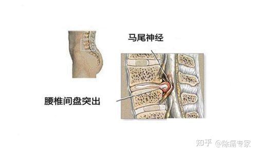 腰椎间盘突出症患者的棘突,棘突旁或棘间隙有压痛,通俗讲就是背部中间