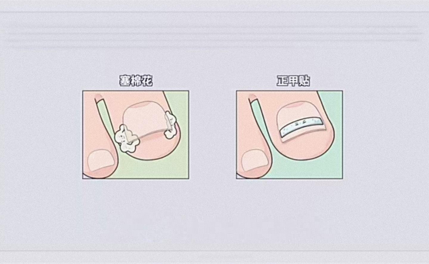 如何正确修剪指甲甲沟炎是怎么形成的