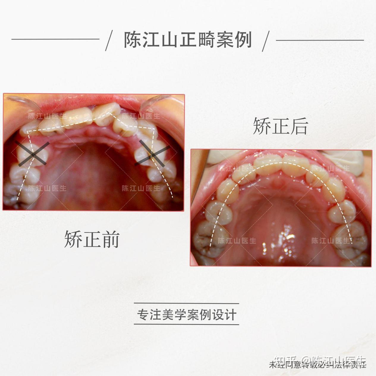 为什么总拔4/5号牙?有什么区别?