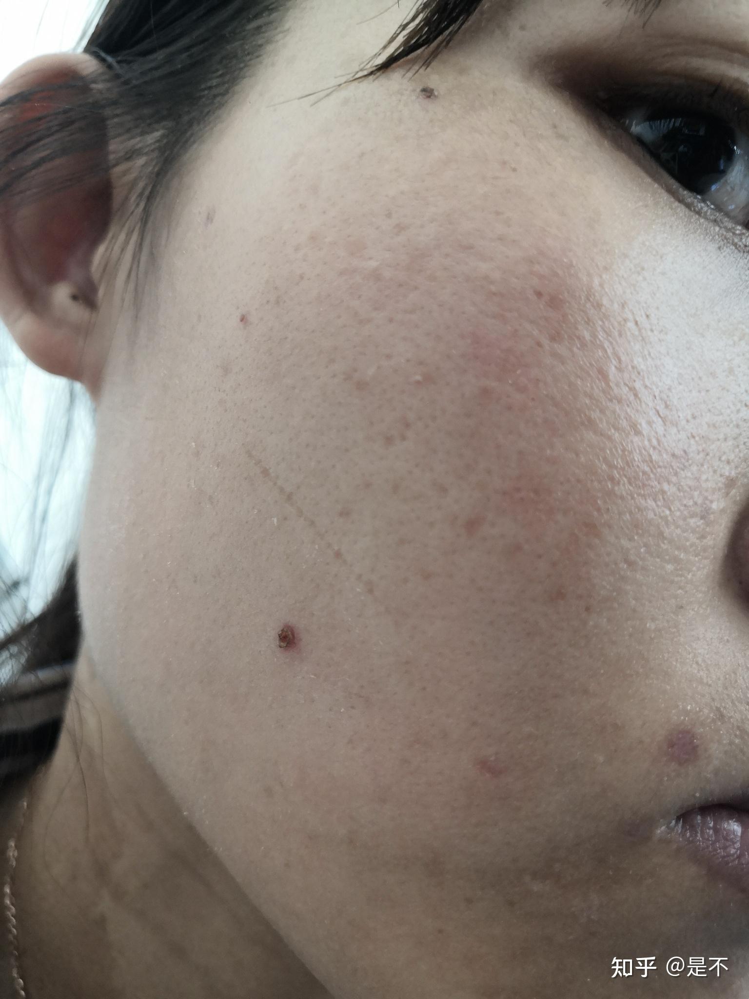 药水点痣第19天,期间怎么洗头 - 知乎