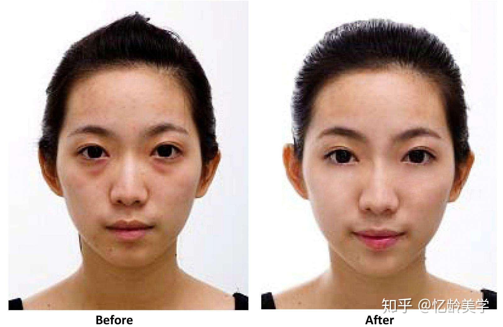 但卧蚕是椭圆型;眼袋不论脸部表情为何都会出现,卧蚕笑起来才会特别