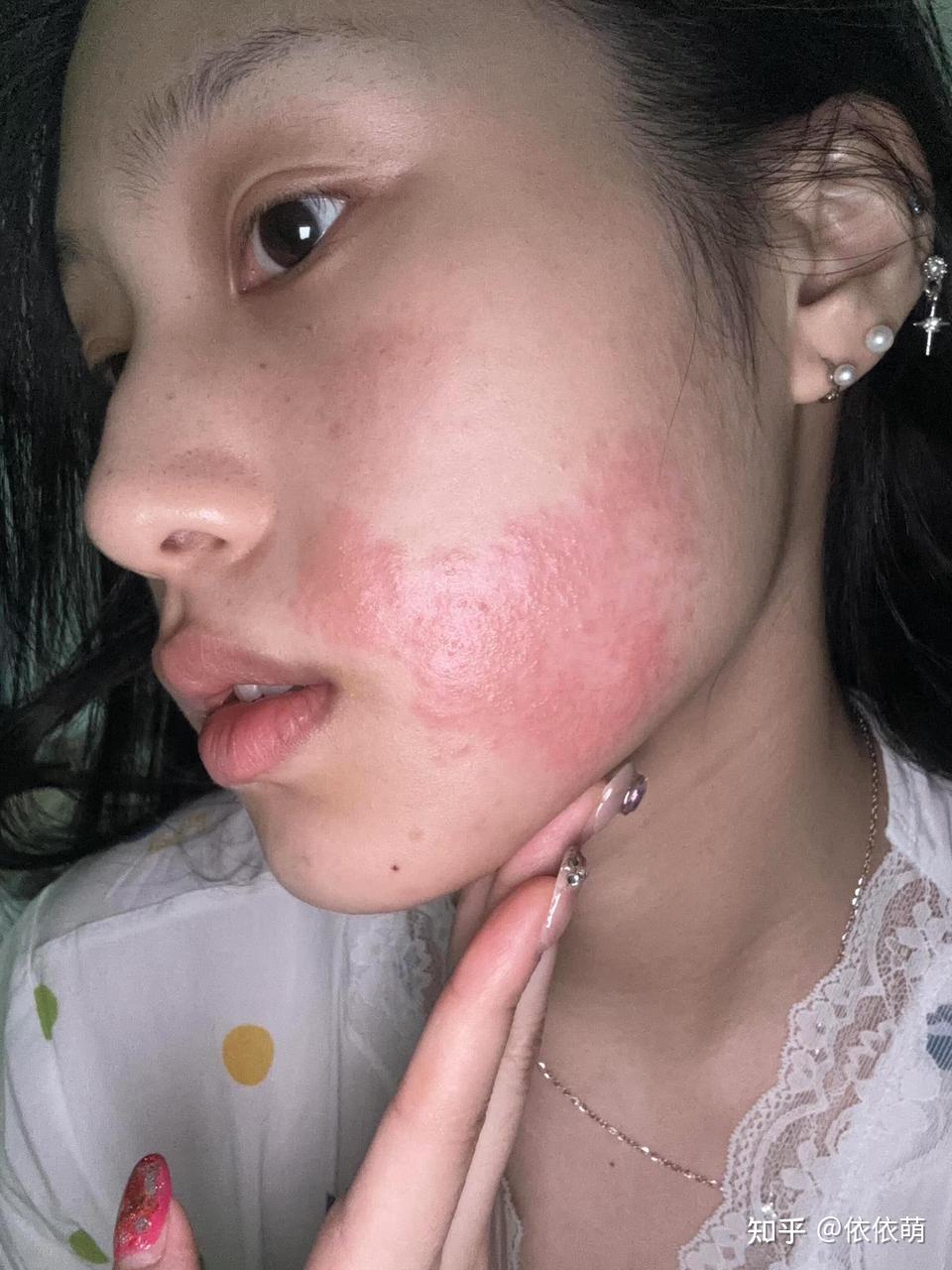 脸上长了湿疹怎么做才不会留黑印?