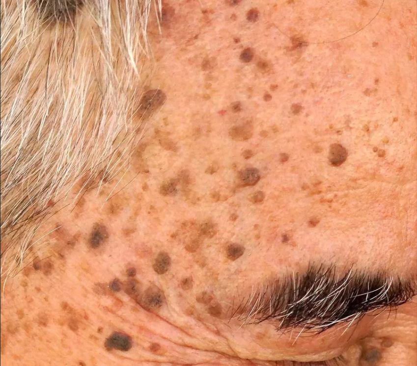 注意黑痣你可能得了老年疣