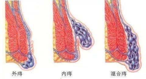 婴儿肛周炎图片