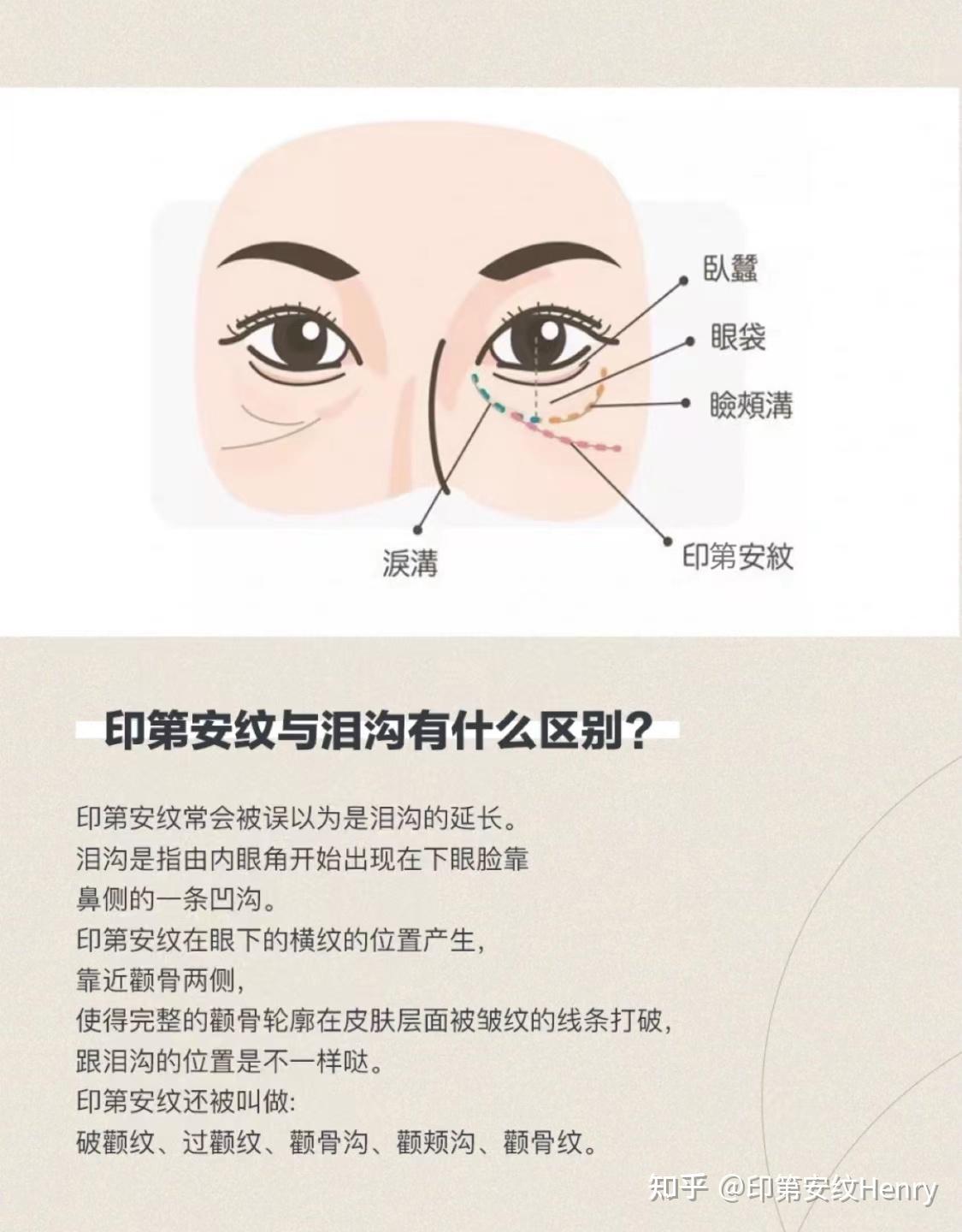 印度安纹和印第安纹傻傻分不清1张图教会你详细分辨